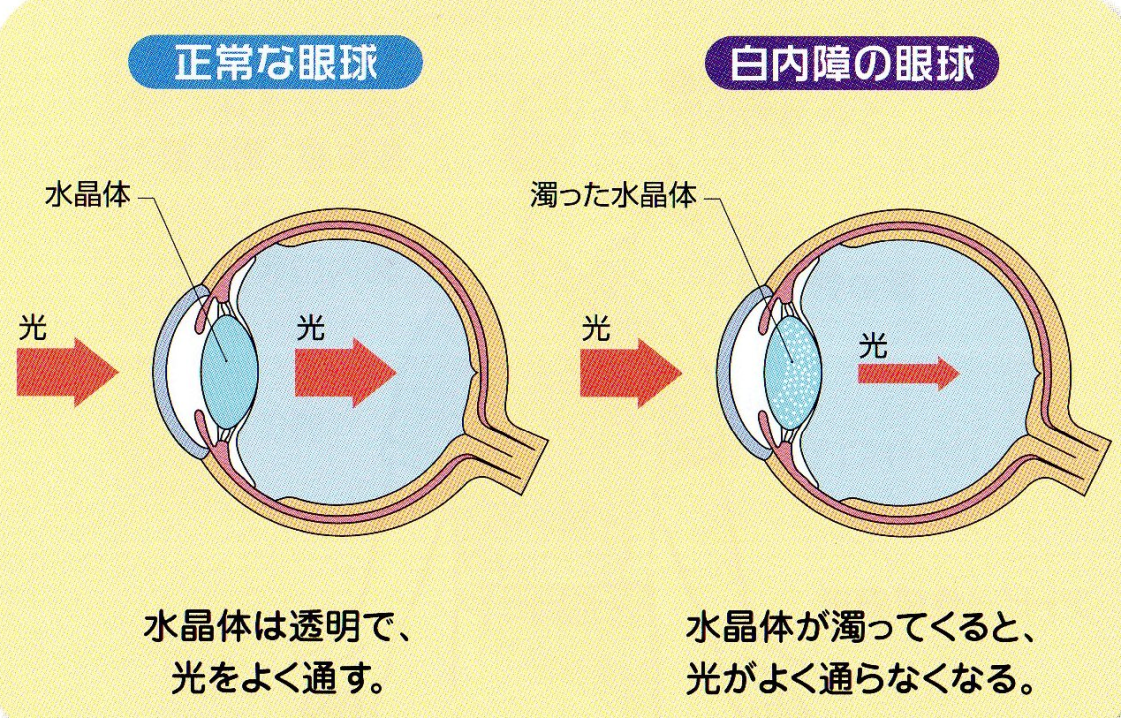 白内障とは