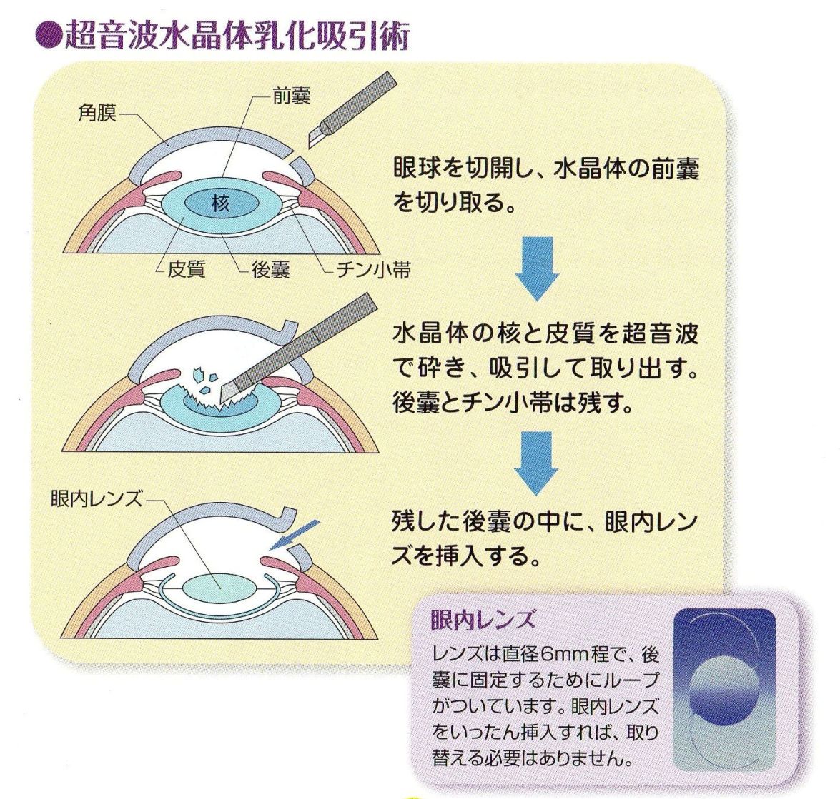 白内障の手術