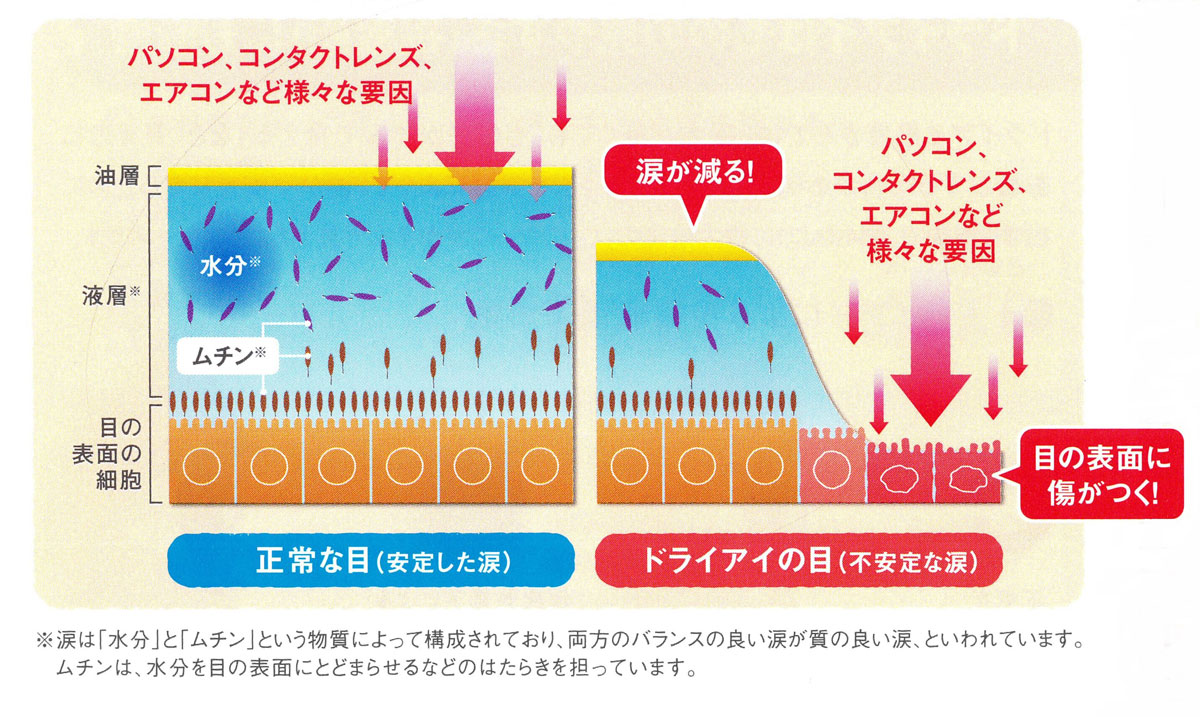 ドライアイについて