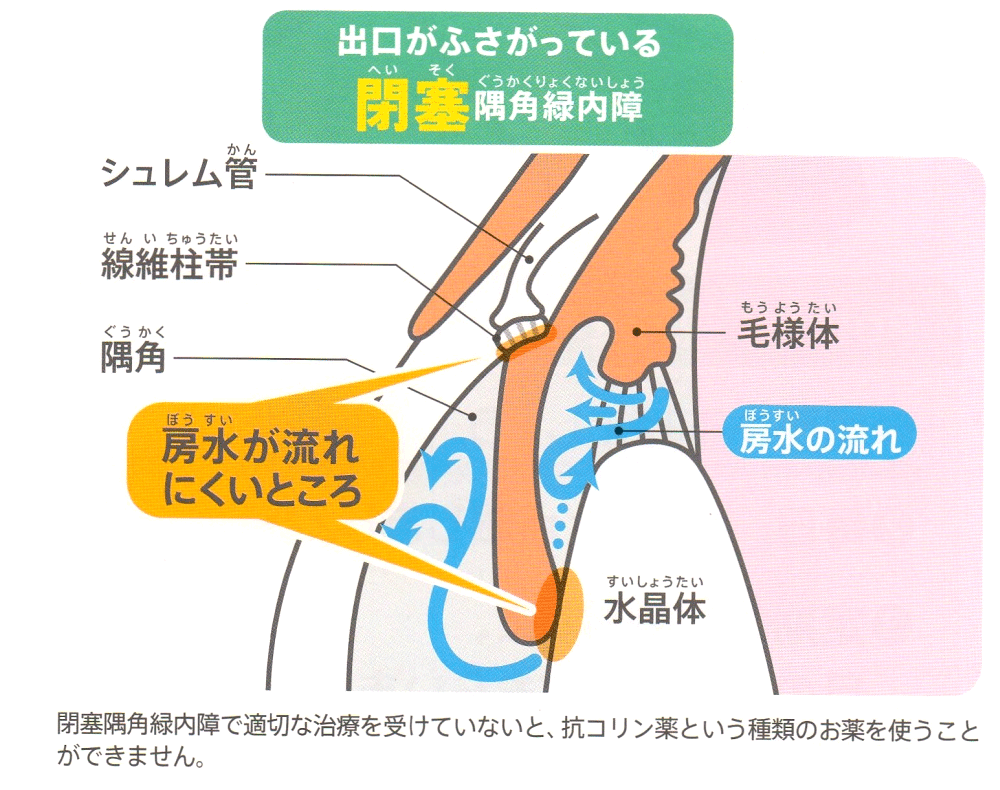 開放隅角緑内障・閉塞隅角緑内障とは